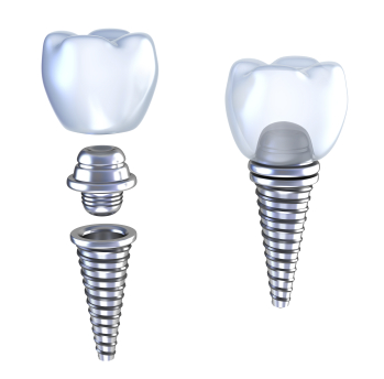 Image of a dental implant and its components, at Stephen L Ruchlin DDS in Rochester, NY.