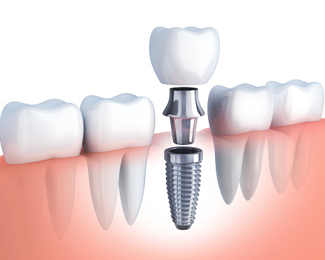 Image of a dental implant being assembled at Stephen L Ruchlin DDS in Rochester, NY.