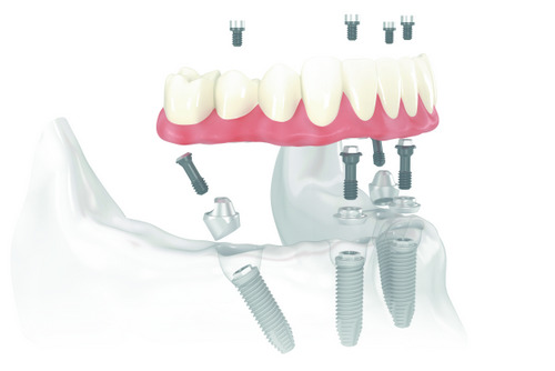 Diagram of All-on-4 Treatment Concept.