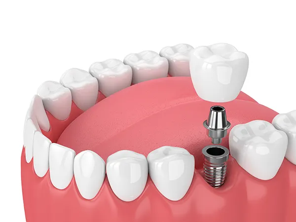 Image of a dental implant and its components at Stephen L Ruchlin DDS in Rochester, NY.